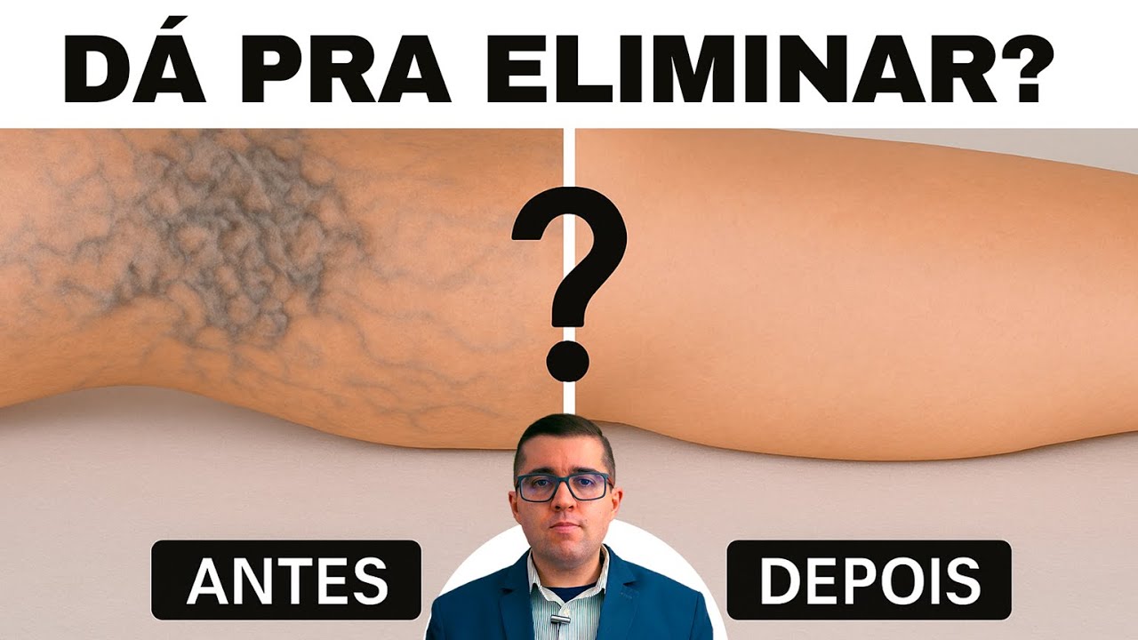 É Possível Eliminar as Varizes de Vez? Descubra a Verdade Agora!