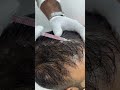 QR 678 Is Best Treatment For Hair Loss More Advance Than Anything Like PRP GFC Hairlosstreatment