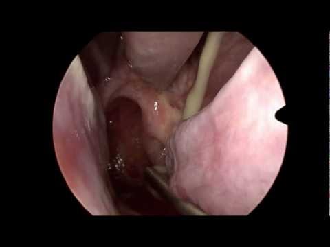 Sinusitis aguda en HD