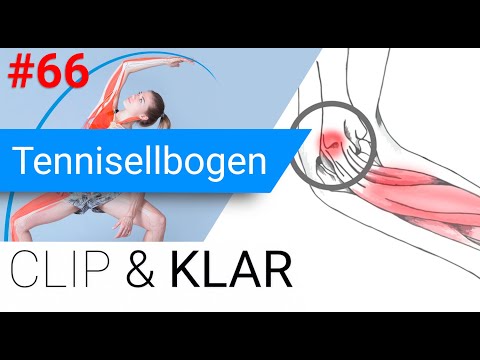 Tennisellbogen erklärt - Meist ganz ohne Tennis