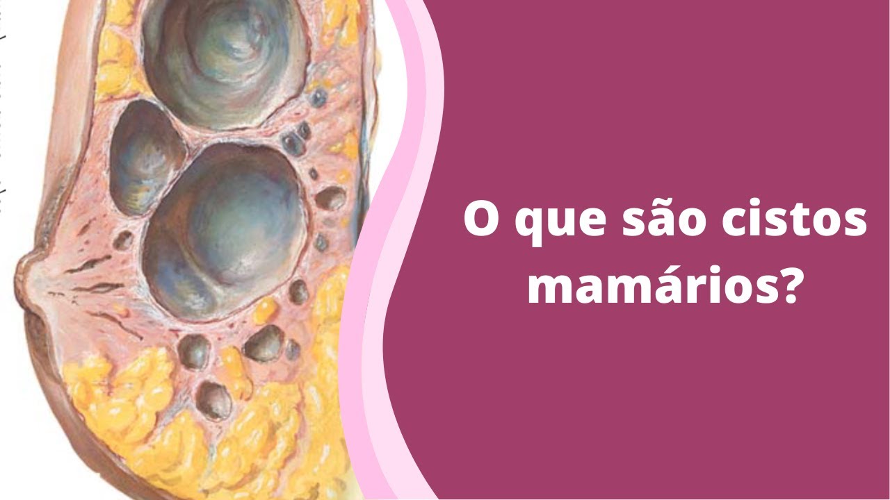 O que são cistos mamários?