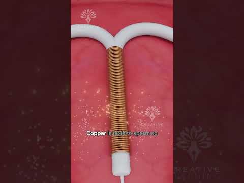 What Happens Inside Your Body After Copper T - Intrauterine Device (IUD) #shorts #pregnancy