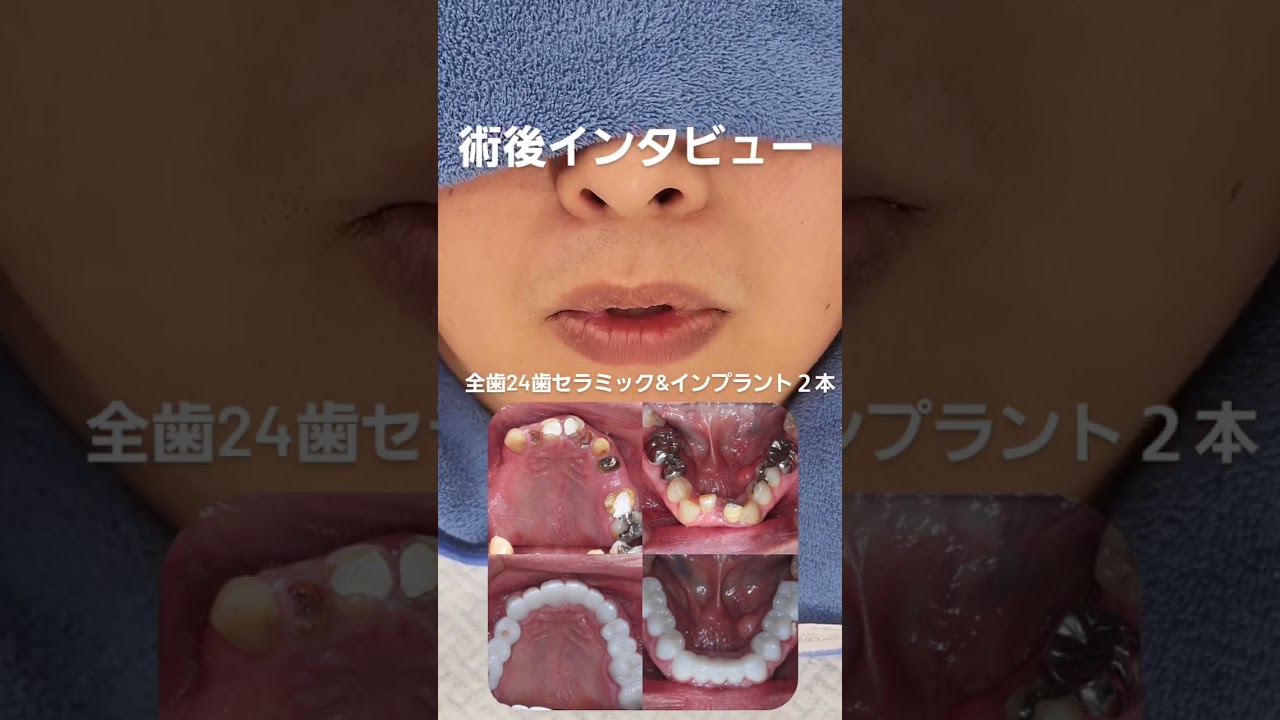 全24歯今クリアートダイヤモンドセラミック、インプラント２本併用です。全てをイチから再構築して、なお最も美しくを追求していきました。#セラミック#インプラント#ダイヤモンド今井院長