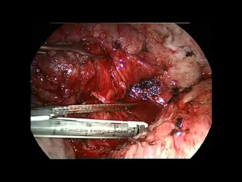 Left Lower VATS Lobectomy For Intrapulmonary Sequestration