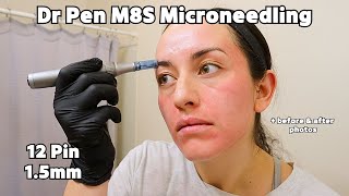 At Home Microneedling for Acne Scars | Dr. Pen M8S Results (12 pin)