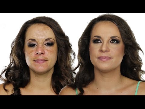 Eliminazione laser di posti di pigmentary prima di e dopo una fotografia Lancaster contro posti di pigmentary