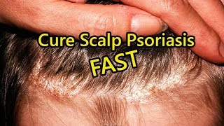 Scalp Psoriasis Home Remedies - How to Cure Scalp Psoriasis FAST