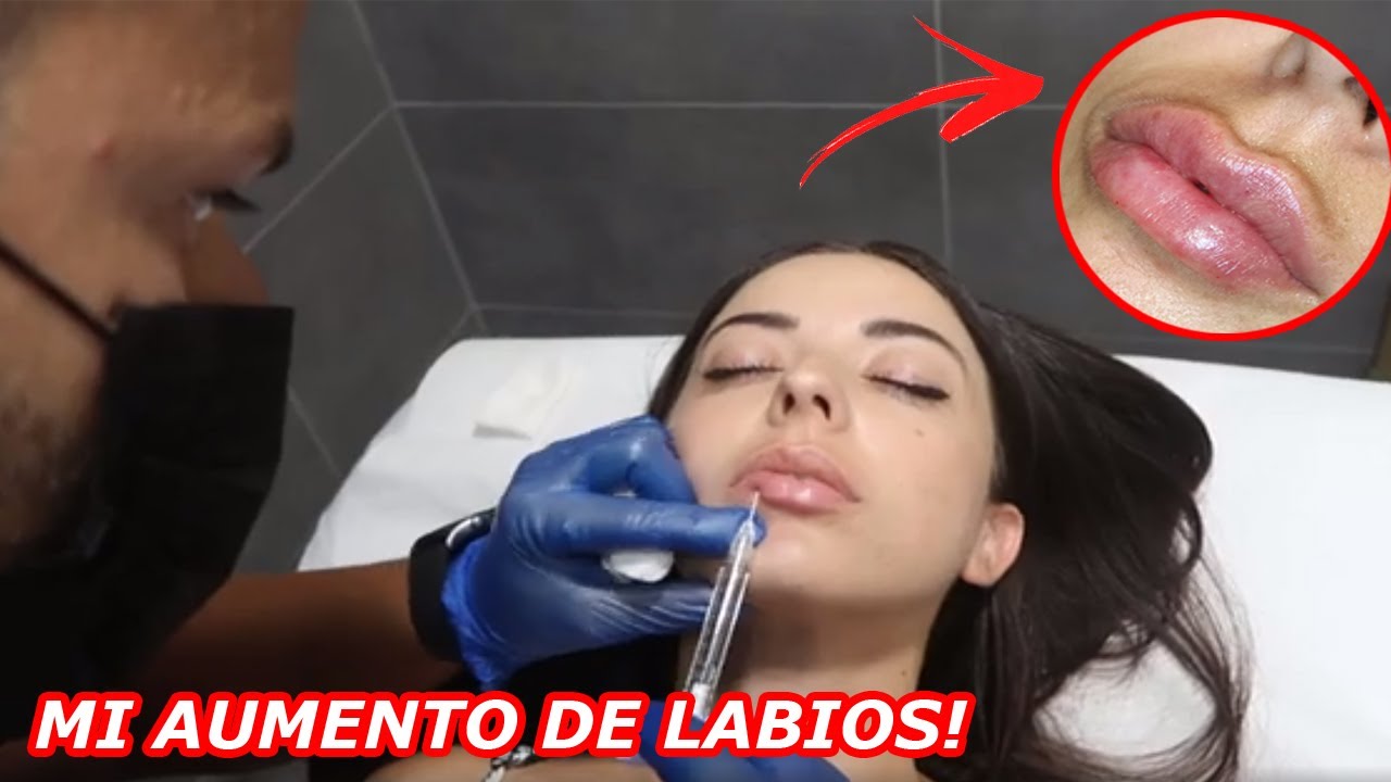 👄MIS NUEVOS LABIOS👄 RELLENO CON ÁCIDO HIALURÓNICO CON DORSIA!