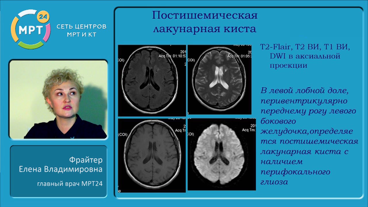 Постишемические кисты мозга. Постишемические кисты головного мозга. Постишемическая киста мрт. Постишемические кисты головного мозга на мрт.