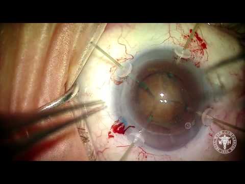 Mature cataract removal with loose zonules