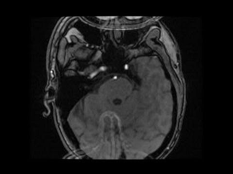 Tabletten dibazola Latein Arterielle Hypertonie, zerebrovaskuläre