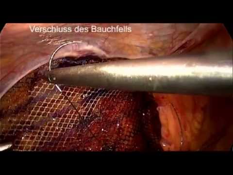 Behandlung von Arthrose taraz Gymnastik Hernie zervikalen und lumbalen Wirbelsäule