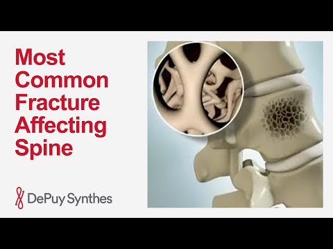 What Is a Vertebral Compression Fracture? Main Causes and Treatment Explained | DePuy Synthes