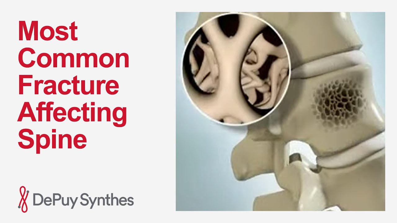 What Is a Vertebral Compression Fracture? Main Causes and Treatment Explained | DePuy Synthes