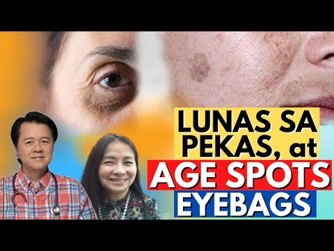 Lunas sa Pekas, Kulubot, Age Spot at Eyebags - By Doc Willie Ong#1509