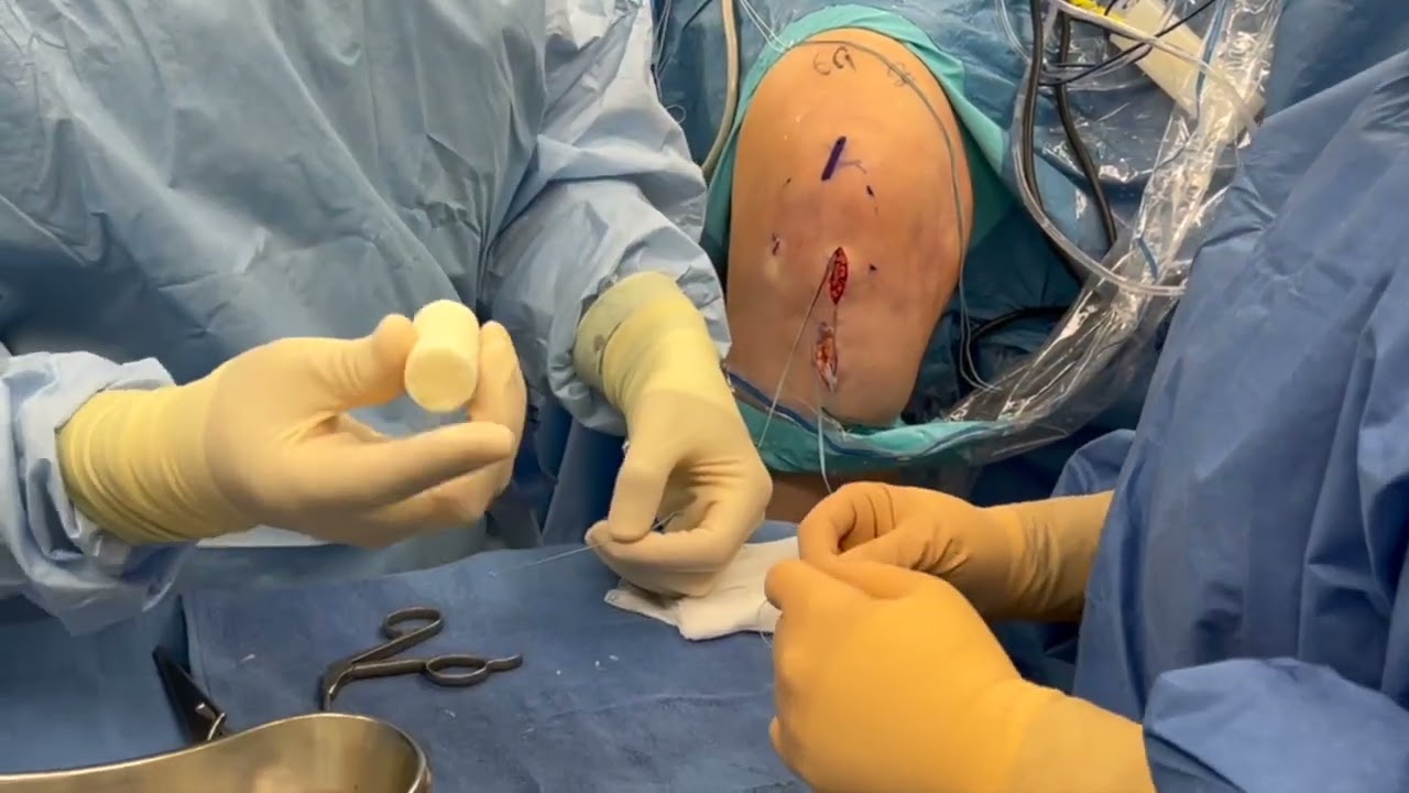 Dr. Garcia’s updated BEAR ACL repair technique with tightrope fixation