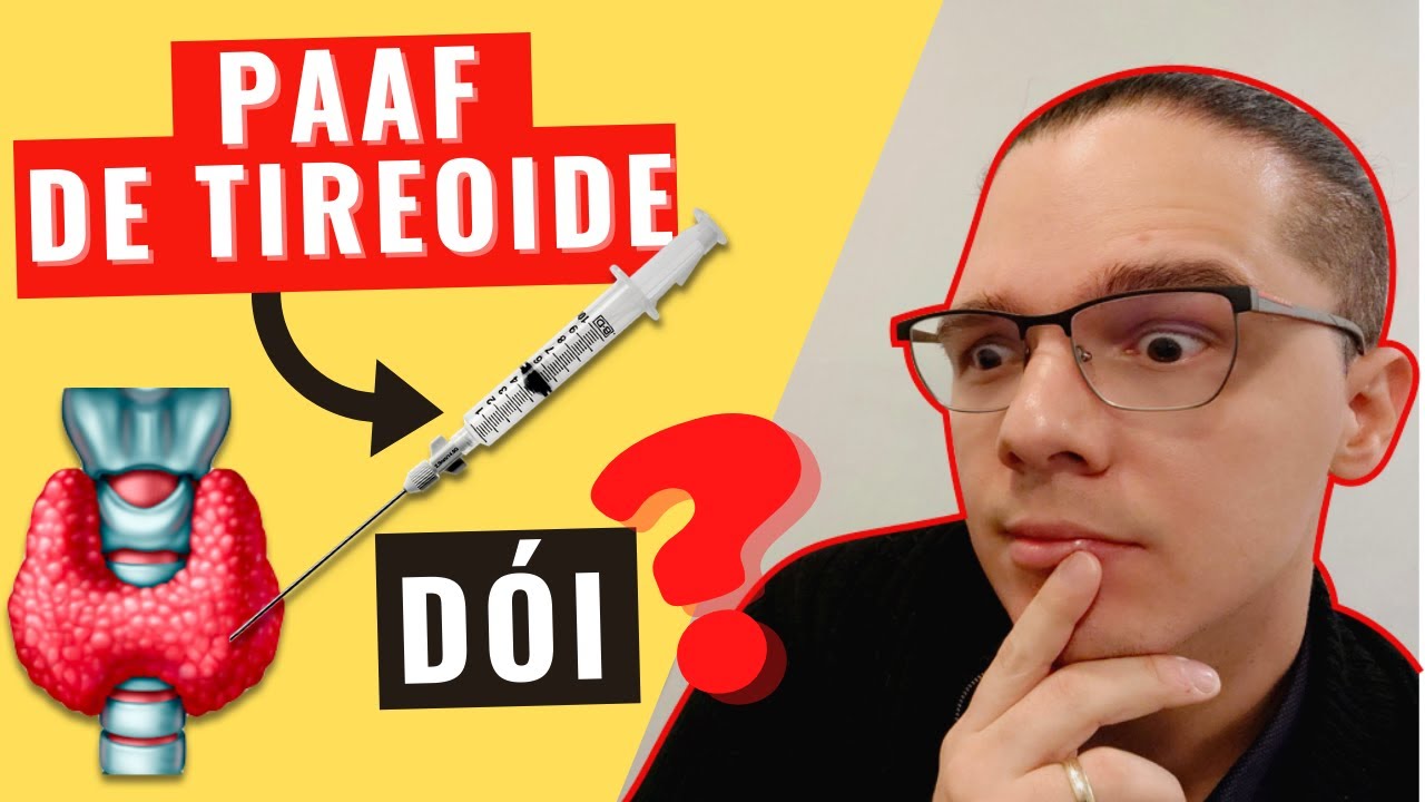 PUNÇÃO (PAAF) DE TIREOIDE GUIADA POR ULTRASSOM DÓI? Veja mais sobre a ANESTESIA na PAAF da tireoide!