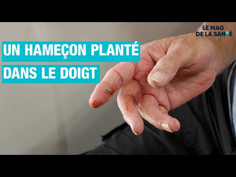 🩸Opérer un DOIGT en urgence 2/5 - Allo Docteurs