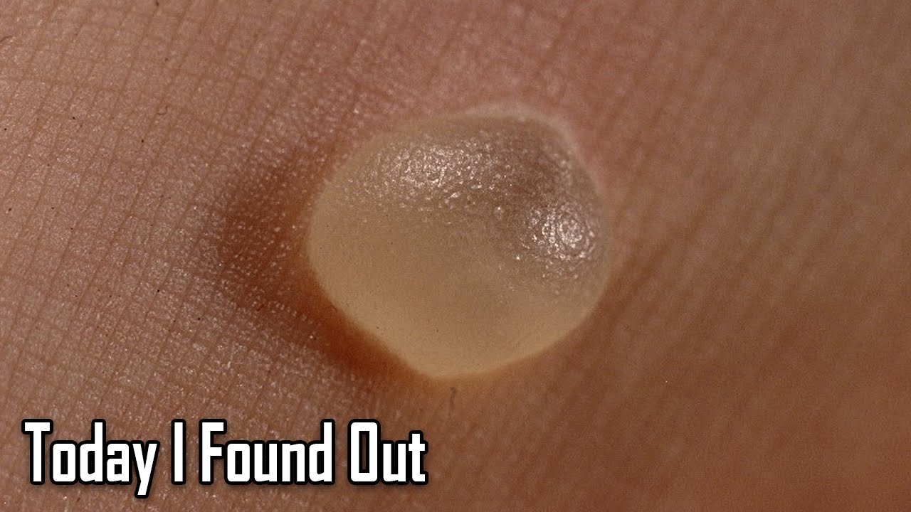 What Causes Blisters?