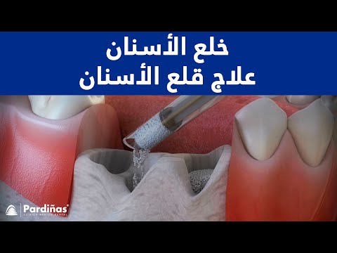 قلع الأسنان – علاج  “socket preservation” ©