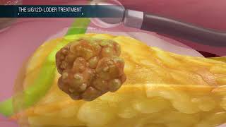 Silenseed - Targeted Therapies for Solid Tumors