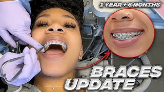 Finally Getting POWER CHAINS On My Braces After 1 Year & 6 Months! | Braces Vlog UPDATE! | KDiani
