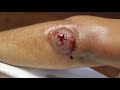 Cupping (Hijama) Therapy After WORM Comes Out From Insect Bite