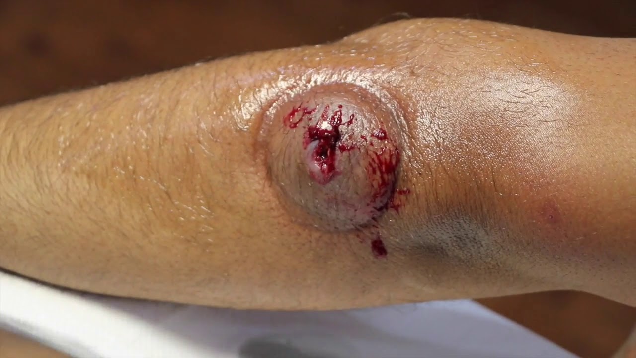 Cupping (Hijama) Therapy After WORM Comes Out From Insect Bite!