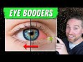 How To Get Rid Of Eye Boogers And Crust 3 Causes And Treatments