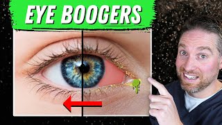 How To Get Rid Of Eye Boogers And Crust (3 Causes and Treatments)