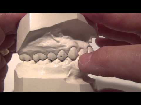 Malocclusion Classification