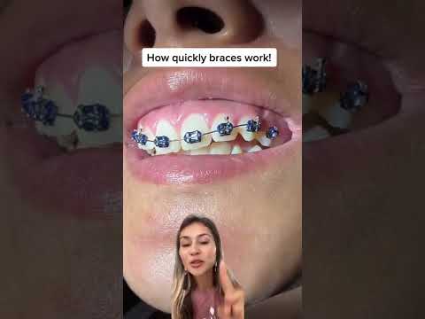 Watch How Fast Braces Work