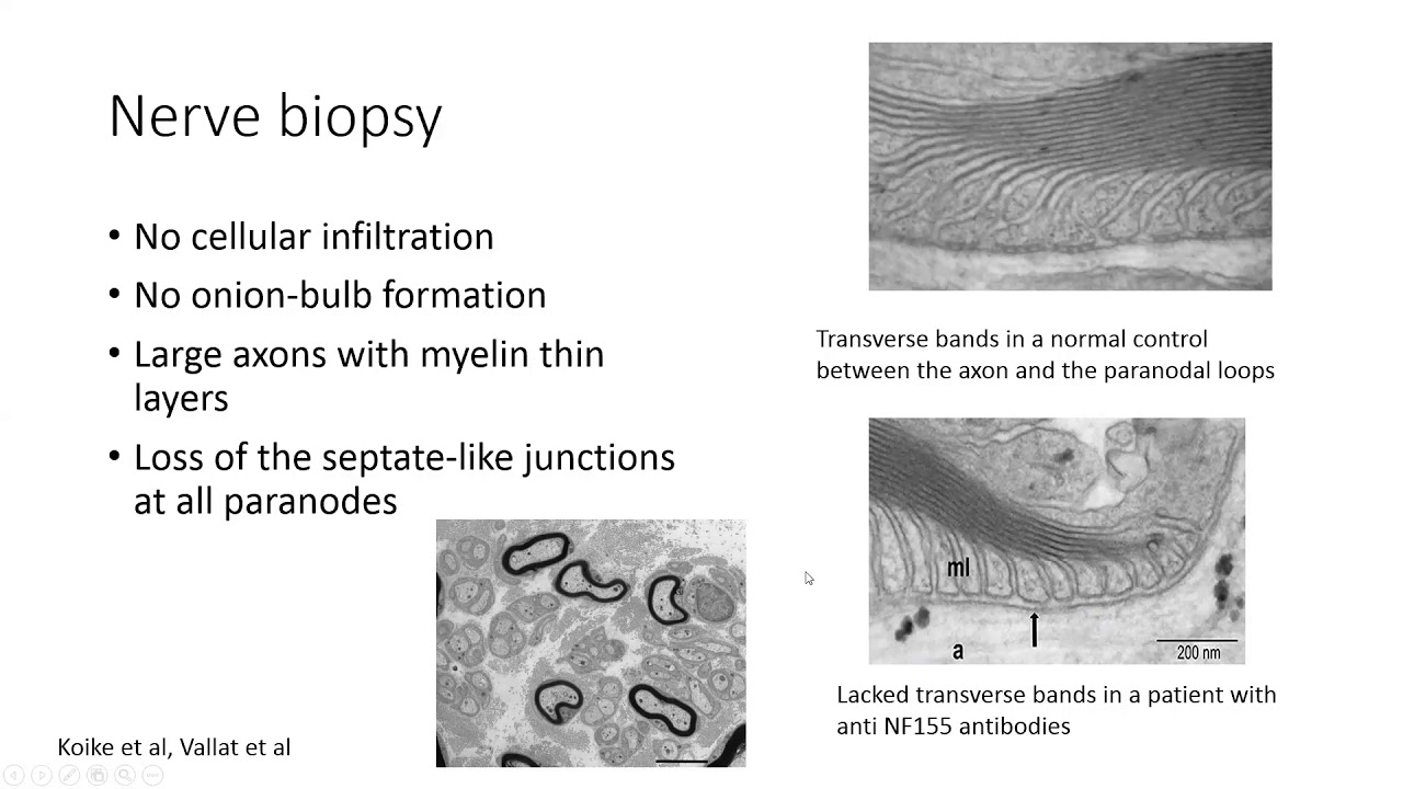 Diagnosis and treatment of CIDP associated with antibodies against node of Ranvier