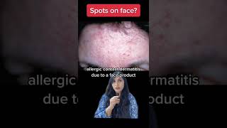 Spots on face? #shorts #dermatologist #dermatology #acne #rosacea #skin #skincare #spots #face