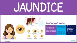 Jaundice: Causes, Classification, Pathophysiology, Types & Treatment Simplified