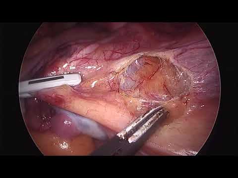 Identification et dissection de l'uretère par voie d'abord rétropéritonéale