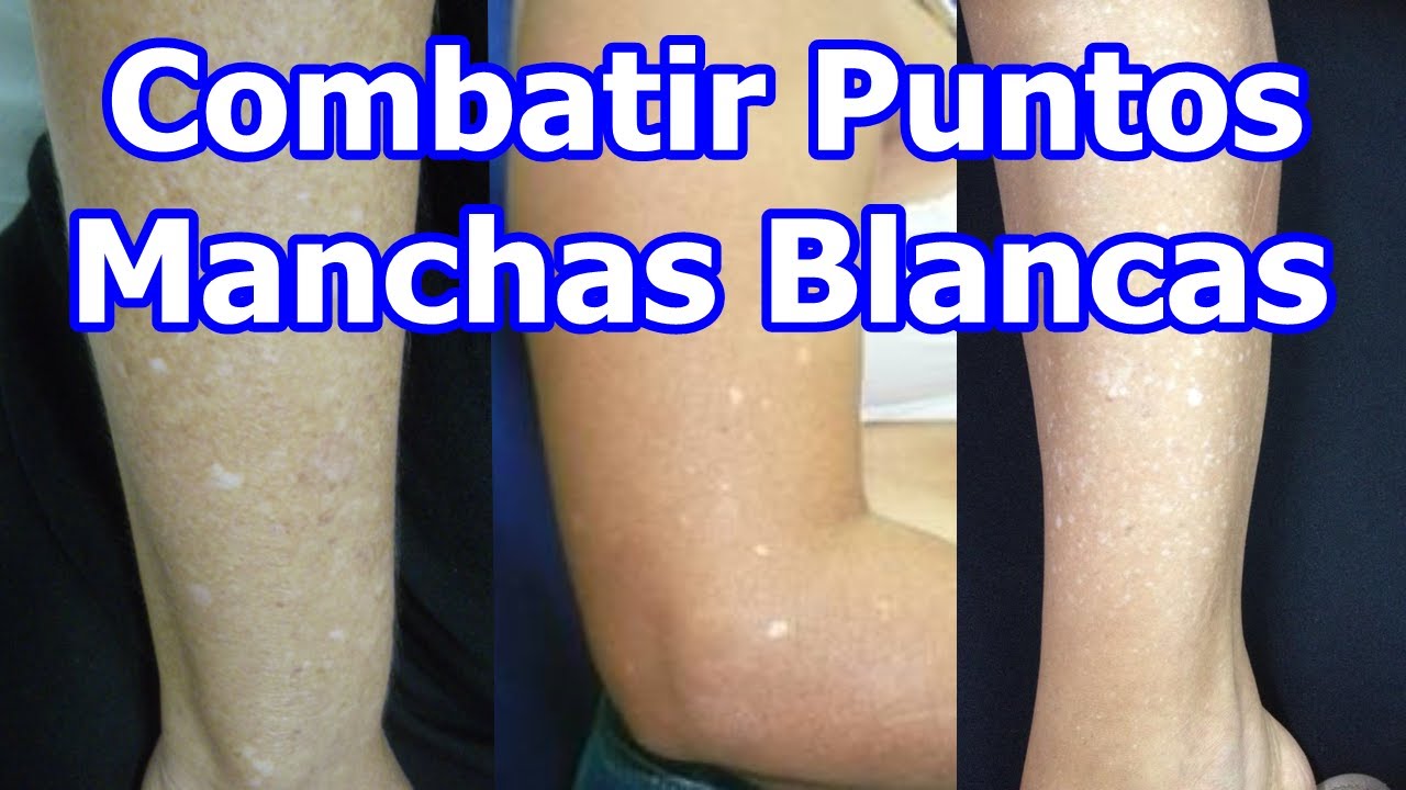 ELIMINAR MANCHAS O PUNTOS BLANCOS DE LA PIEL Y QUÉ LOS CAUSA