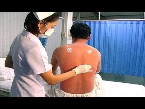 และวิธีการที่จะปกปิดโรคสะเก็ดเงินบนข้อศอก ฮีสตาในโรคสะเก็ดเงิน