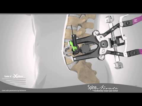 XLIF: Minimally Invasive Lateral Interbody Fusion Nevada, Reno, Sparks, Carson, Northern Nevada