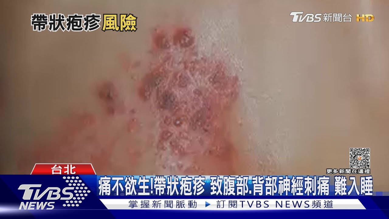 突然發紅持續性神經刺痛長水泡！醫警告：「罹這病」痛不欲生