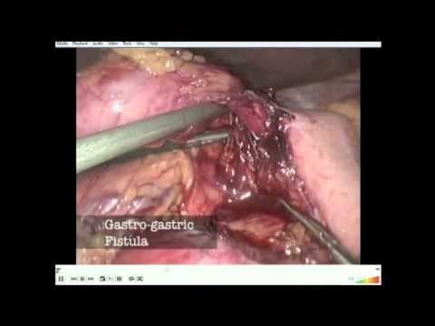 Laparoscopic Revision of Roux-En-Y Gastric Bypass