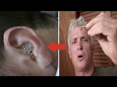 ครีมสำหรับการรักษา neurodermatitis ในใบหน้า ปริมาณคาร์บอนเปิดใช้งานสำหรับโรคสะเก็ดเงิน