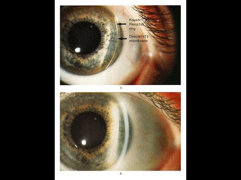 Kayser Fleischer Ring bei Patient mit Morbus Wilson