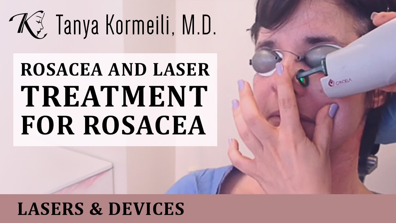 Best Vbeam Laser Treatment Los Angeles & Santa Monica Dr. Tanya
