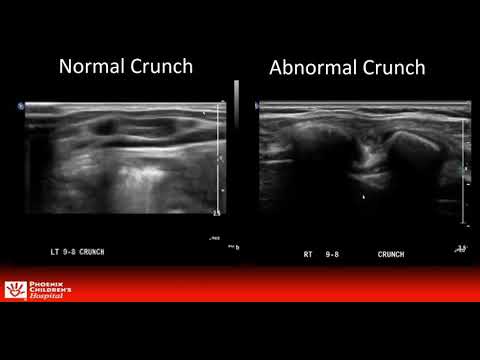 Dynamic Ultrasound for Evaluation of Patients with Suspected Slipping Rib Syndrome (HIGHER VOLUME)