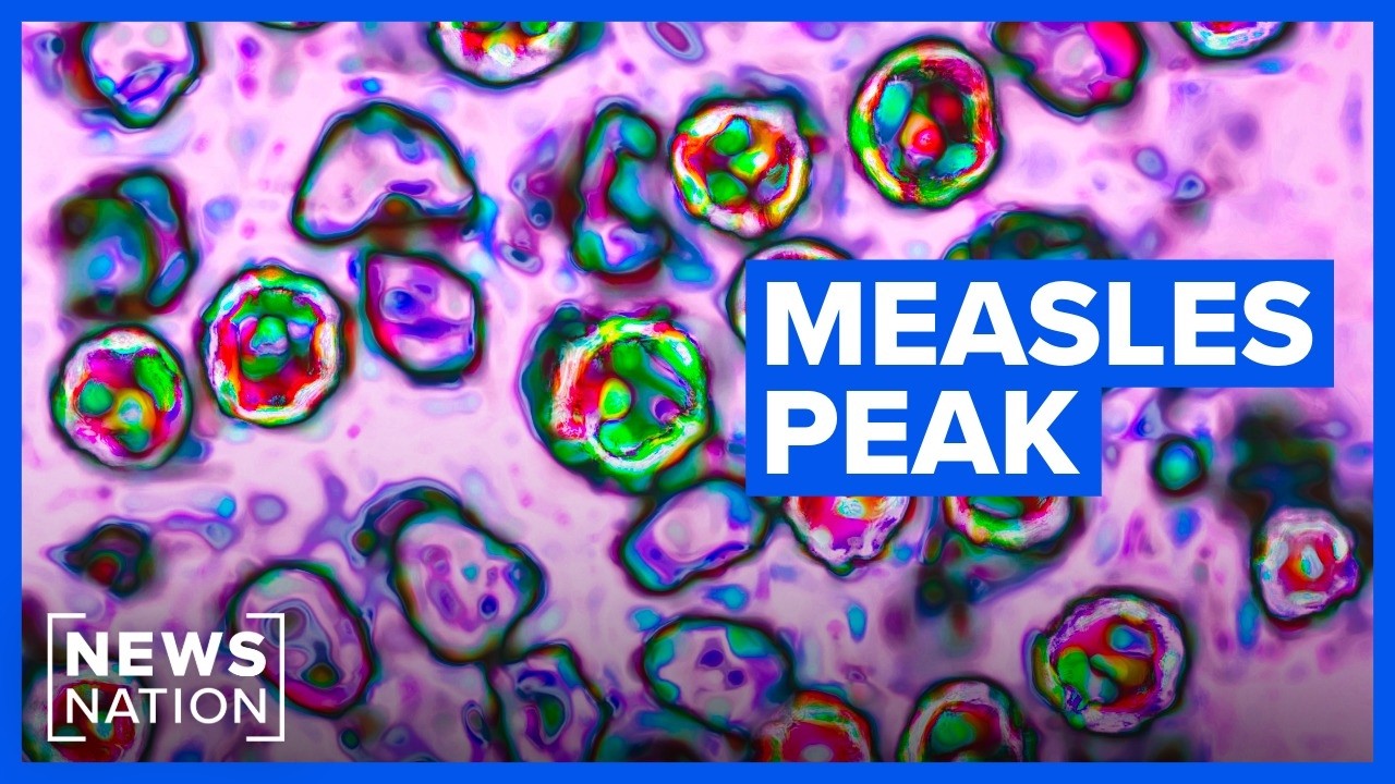 Video: US measles cases reach 2,295 by July 2026, surpassing full-year 2025 total