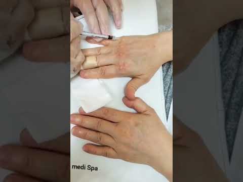 Hands Filler for antiaging and Rejuvenation #skincare #relax #hand