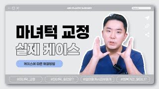 마녀턱 입안절개? 피부절개? 케이스에 따른 수술 방법!