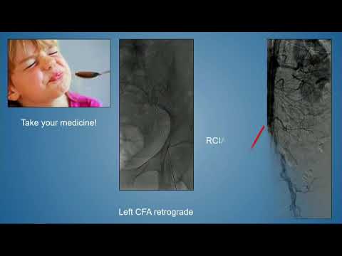 CVI 2019_Friday 7/19_ Aortoiliac Disease _Peter Soukas, MD