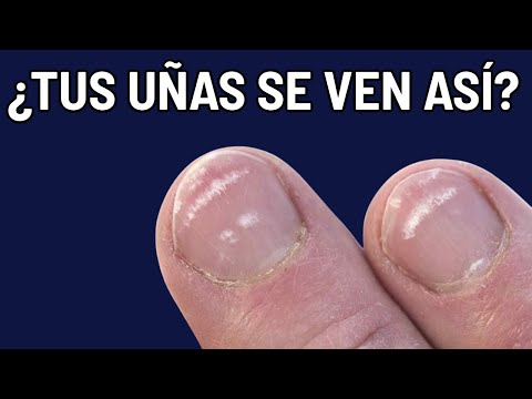 YOUR NAILS ARE WARNING YOU THAT YOU'RE SICK - 12 facts about systemic illness (onycholysis, splin...